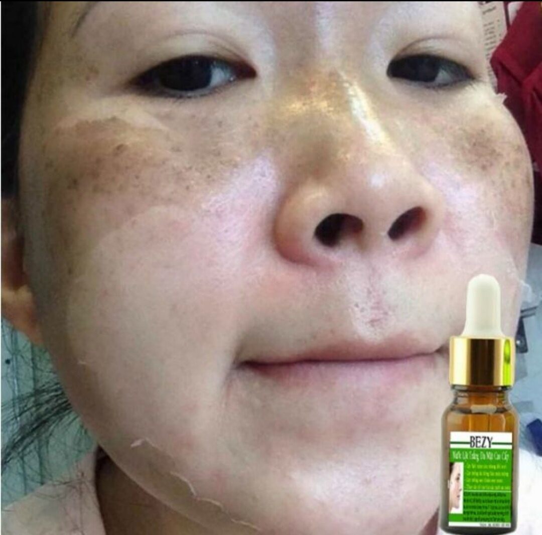 BEZY Lột Thay Trắng Da Mờ Thâm Nám Thái Lan