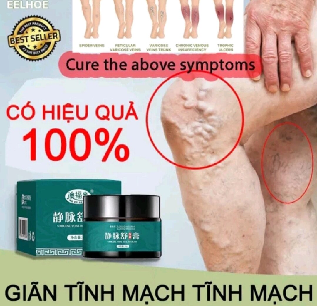 Kem bôi suy giãn tĩnh mạch