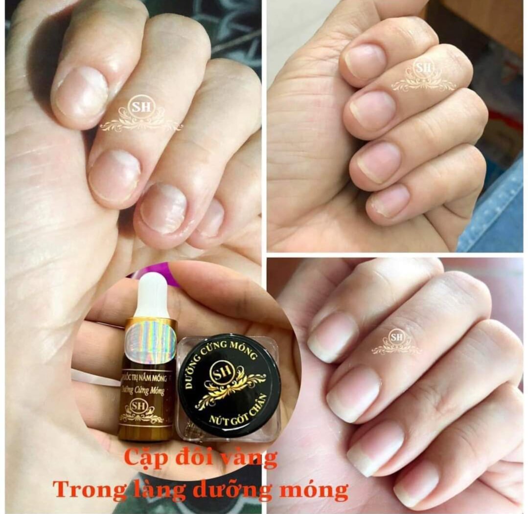 Combo (1 chai nấm+ 1 lọ dưỡng hiệu SH) đánh bay nấm móng+ phục hồi hư tổn ở móng