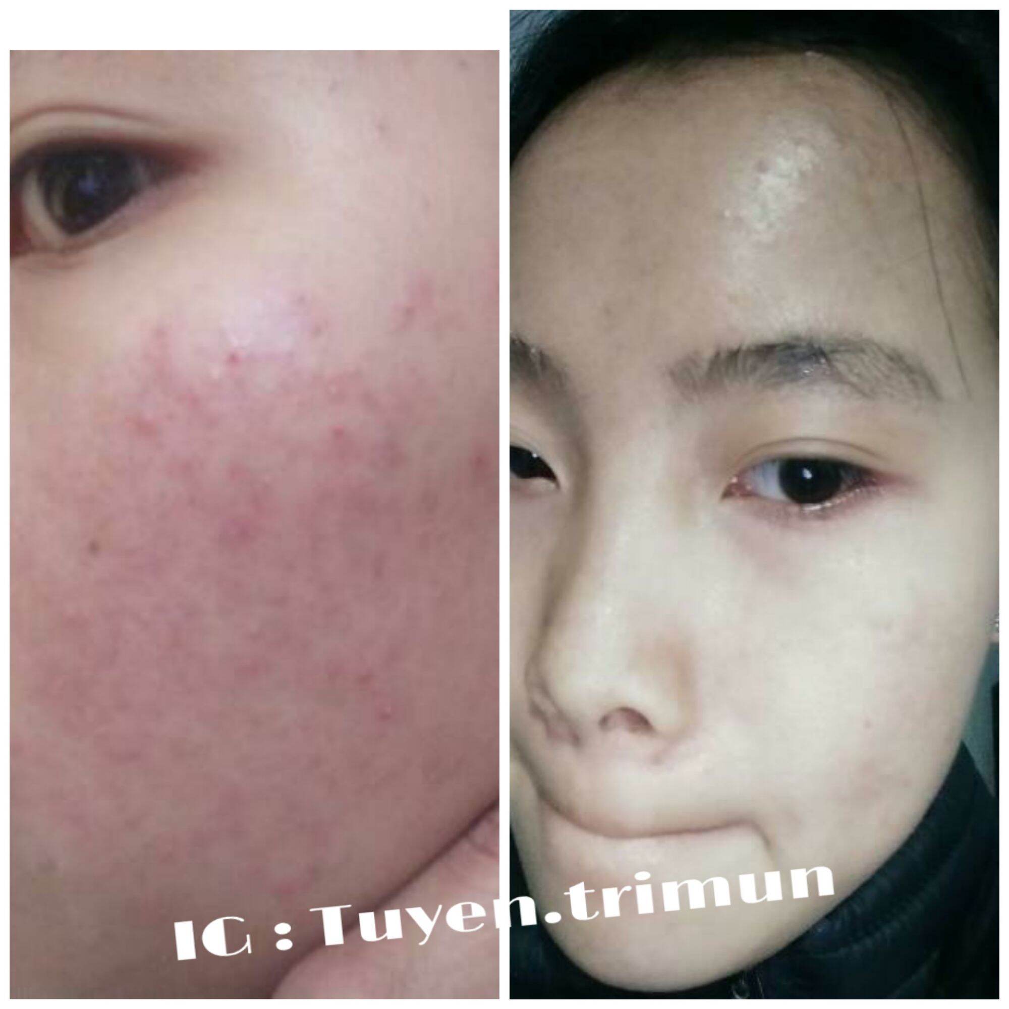 Đông y Sắc Ngọc Nữ  tái tạo da mụn, thâm