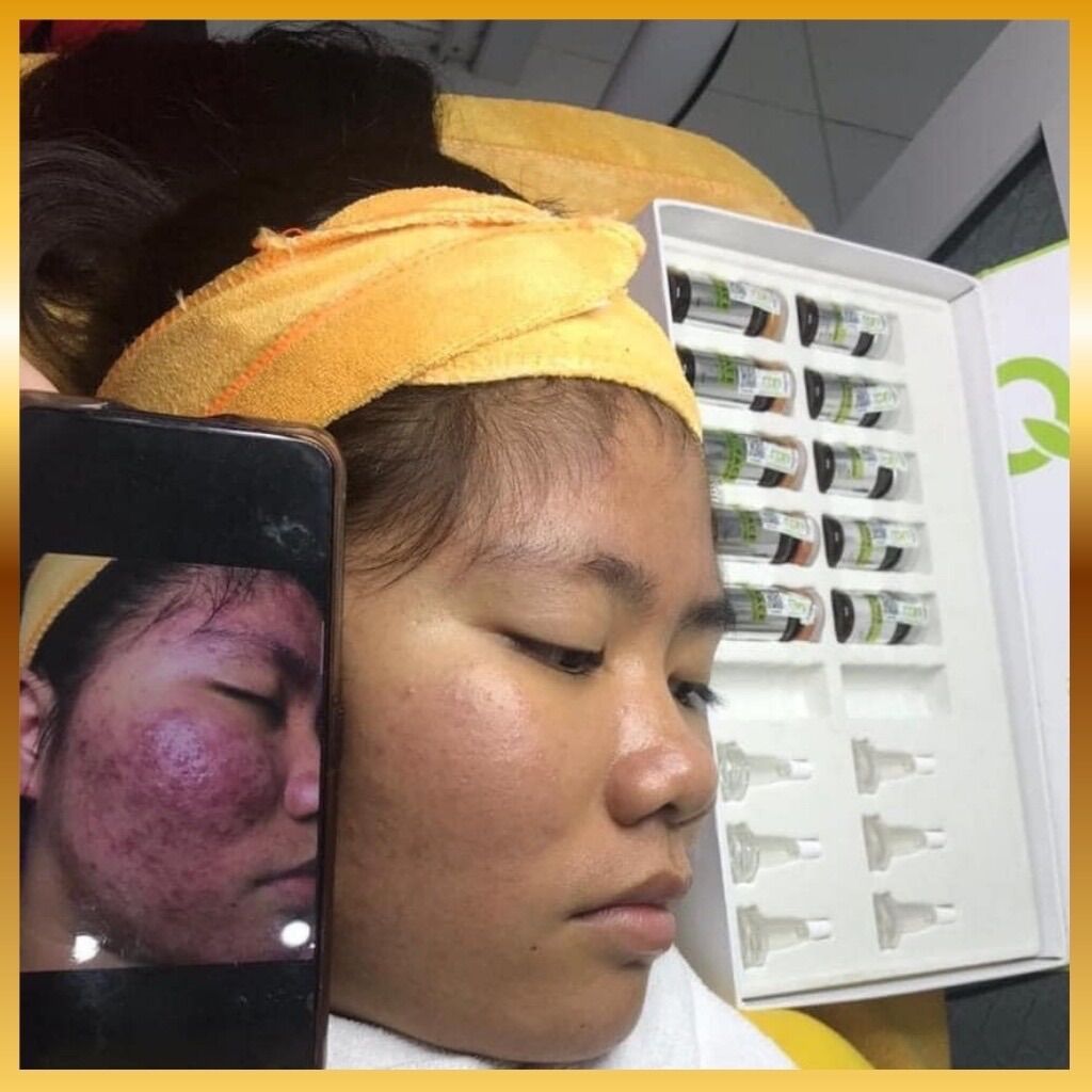 Tế Bào Gốc Mụn Dr. Face Ampoule AC Clear - Ron International