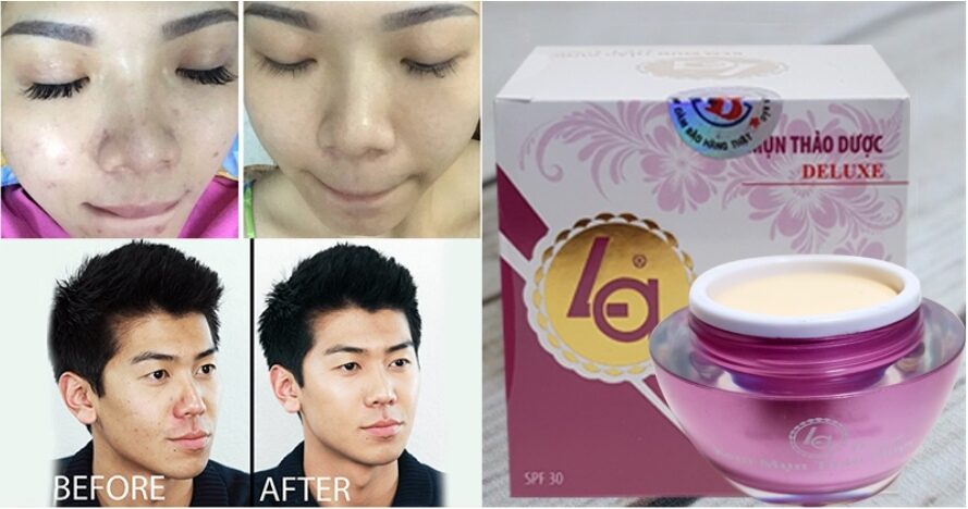 kem Mụn Thảo Dược Deluxe LA 20g