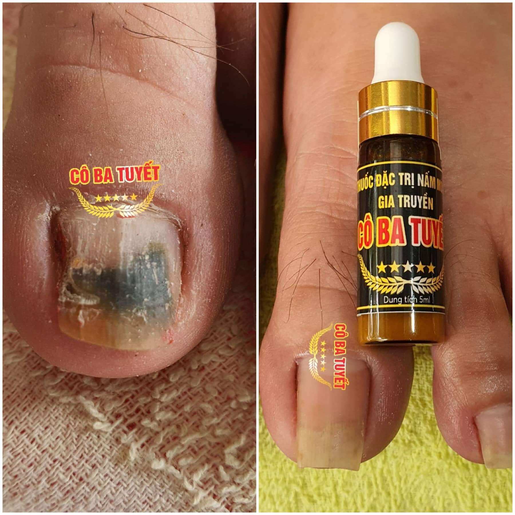 Nâm Móng Tay Chân , Dưỡng Móng