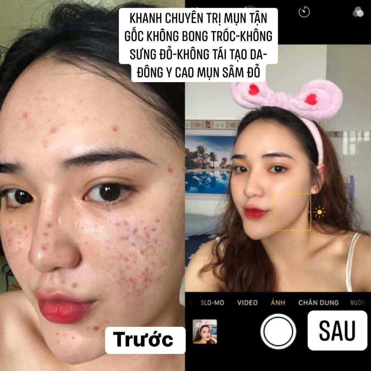 (HCM) Kem Face Cao Mụn Sâm Đỏ 36 Vị MEEA 15g