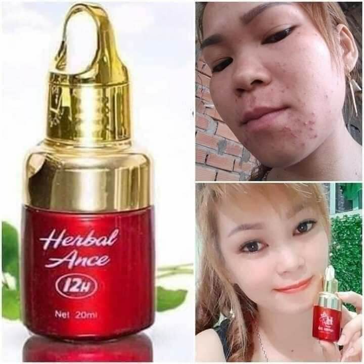 2 chai serum chấm mụn 12h giá 320k