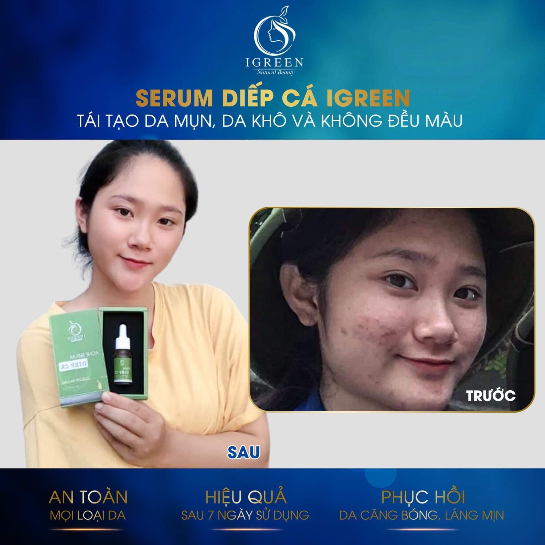 COMBO TOÀN DIỆN IGREEN-SẠCH MỤN,THÂM( serum diếp cá+sữa rửa mặt diếp cá)