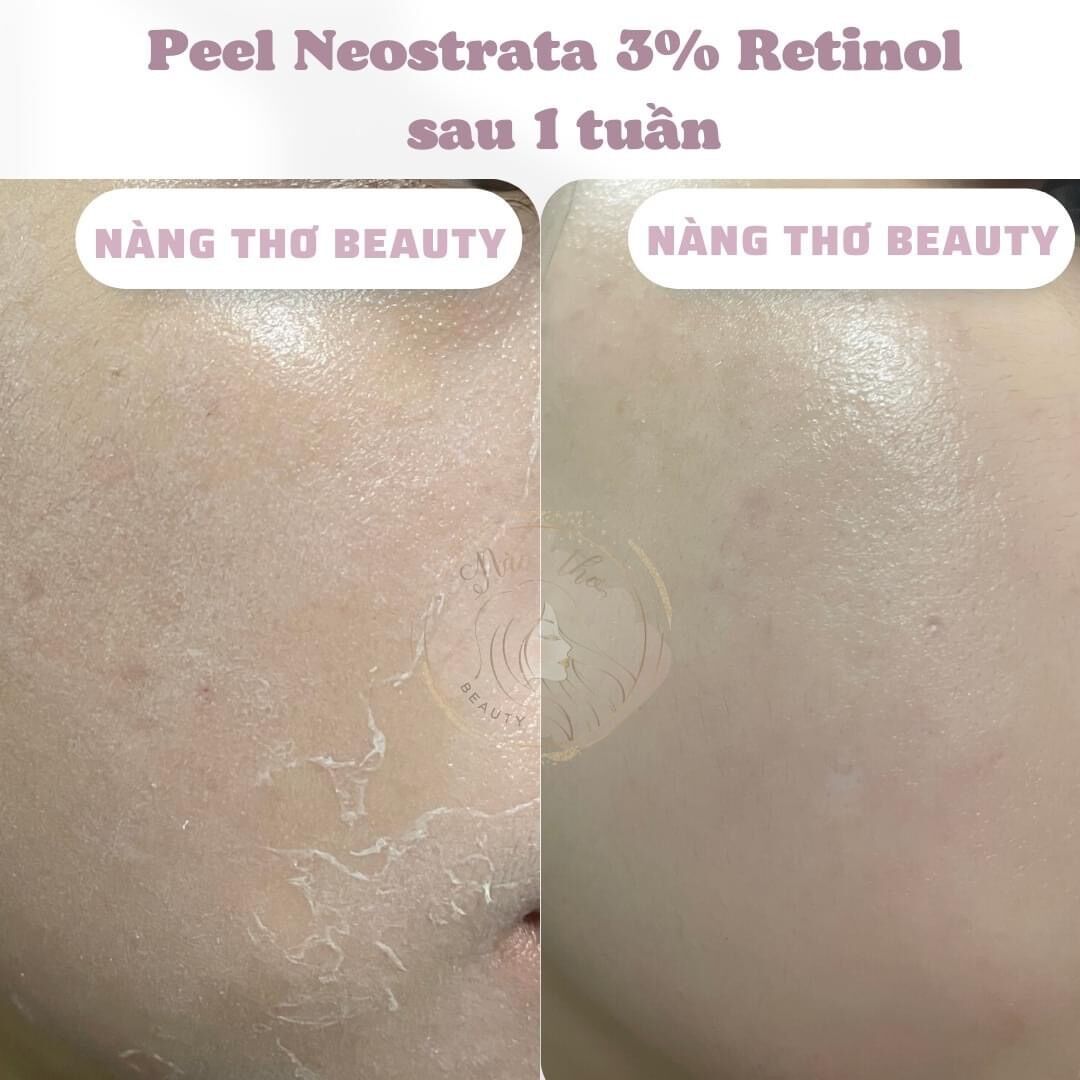 Tinh chất thay da sinh học NeoStrata ProSystem Retinol Peel
