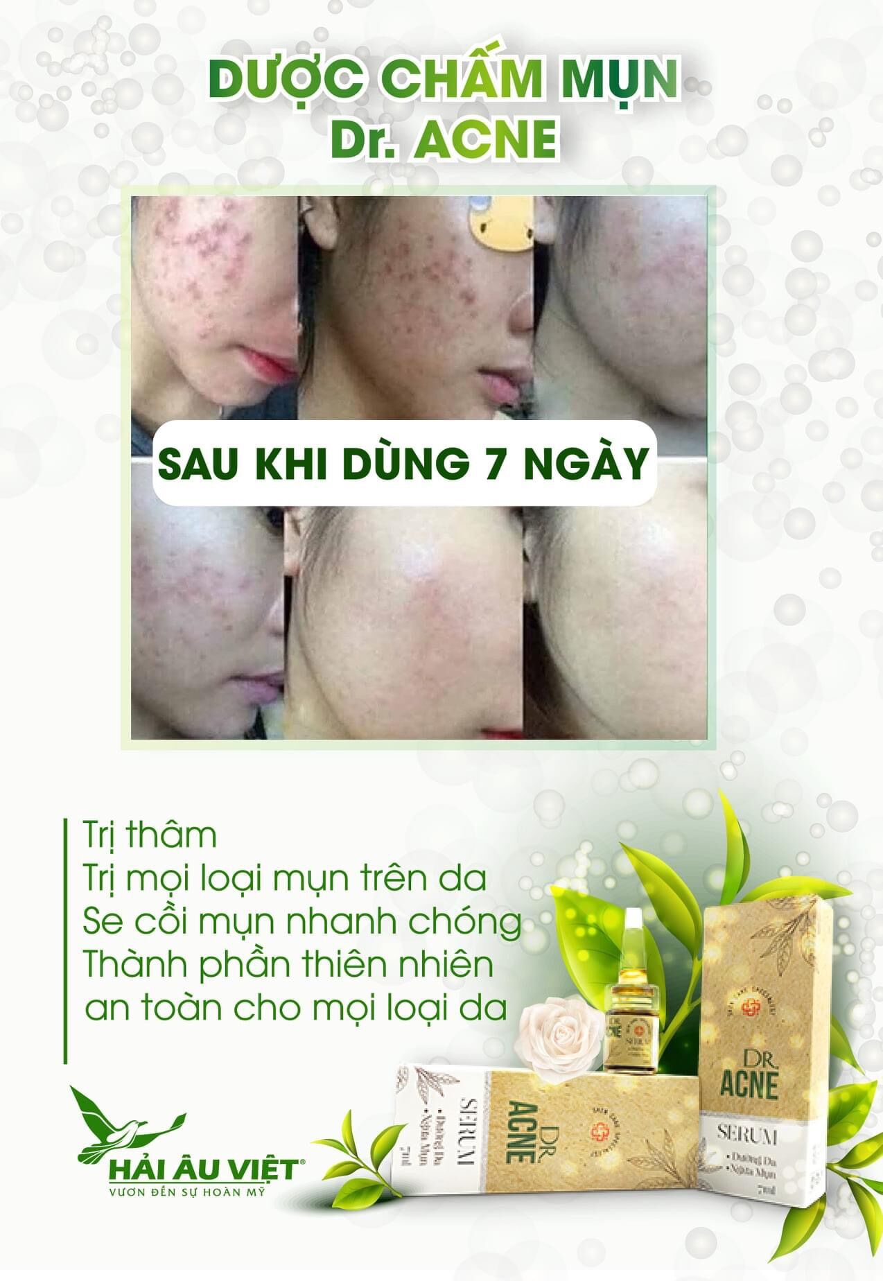 [Combo Ngừa Mụn] Sữa Rửa Mặt Napoli+Dược Chấm Mụn