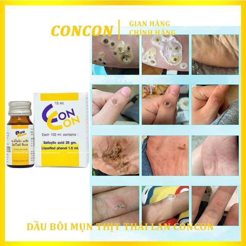 Xoá Mụn Cóc Mụn Thịt ConCon Thái Lan