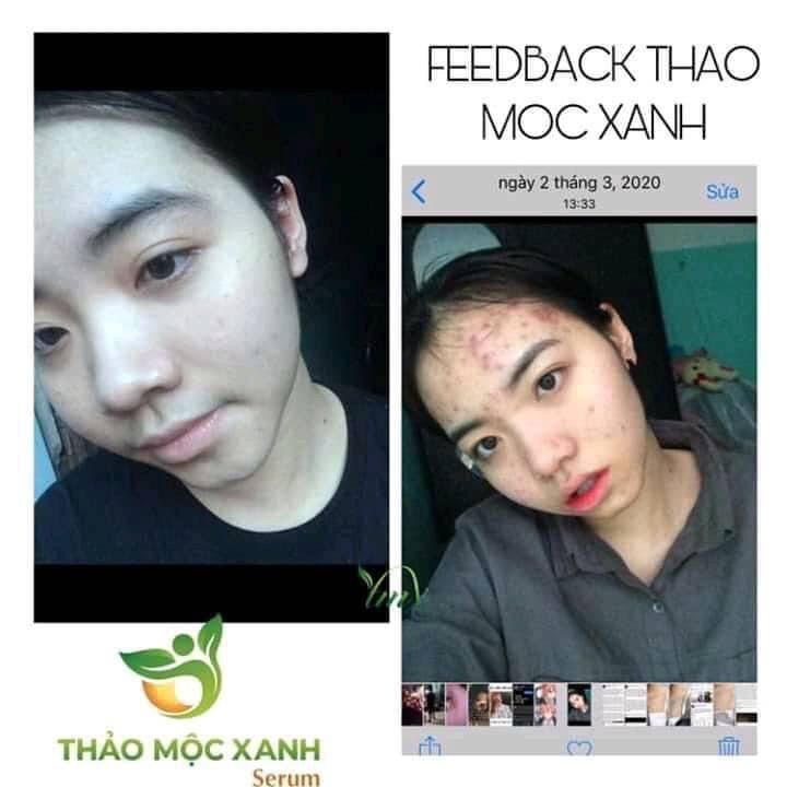 [SẴN HÀNG] Thảo Mộc Xanh sỉ (3 lọ)