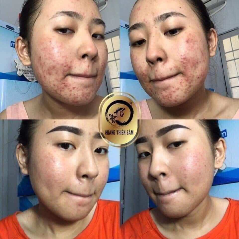 Combo tinh chất tái tạo Hoàng Thiên Sâm