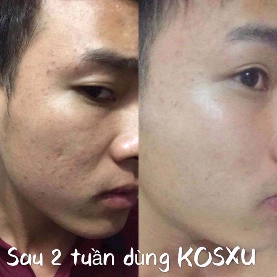 Serum ong Kosxu căng bóng thánh mụn ẩn