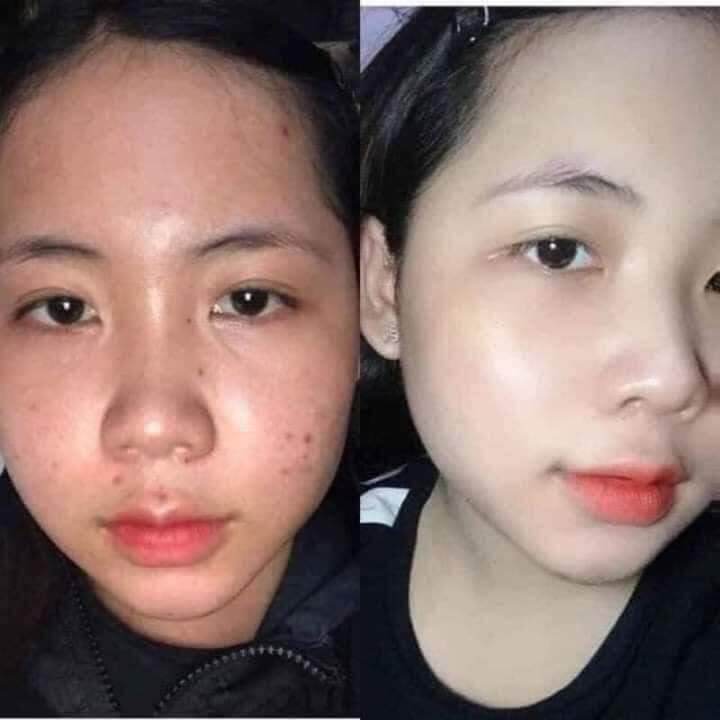 COMBO 5 HỘP KEM MỤN VÀ DƯỠNG DA 2C