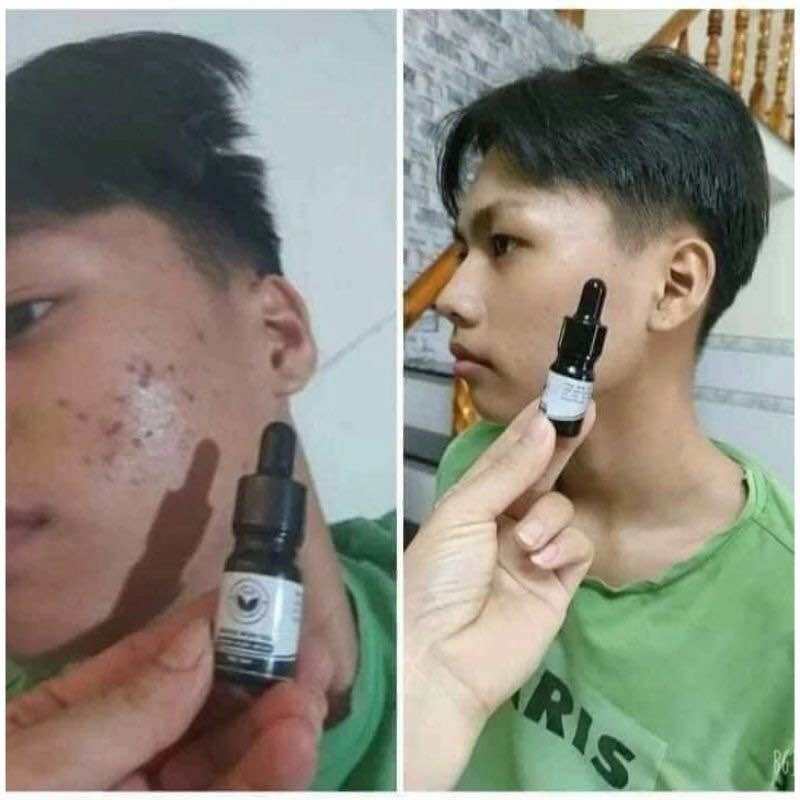 SERUM MỤN TRẦN KIM HUYỀN