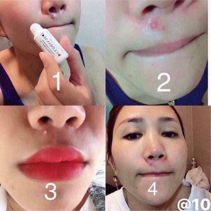 [HCM]Cây chấm mụn CLINDA-M Thái Lan