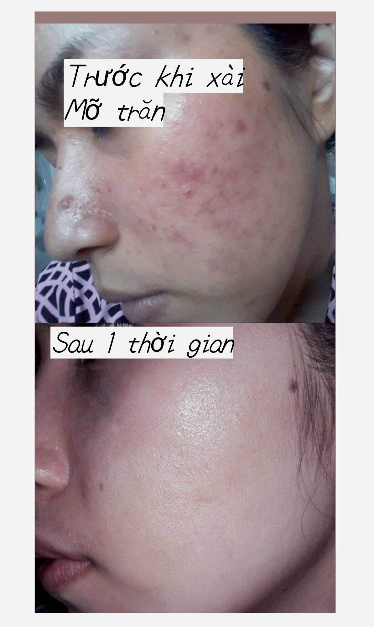 Mỡ Trăn & Ngọc Lan Tây - DÀNH CHO DA MỤN, TRIỆT LÔNG
