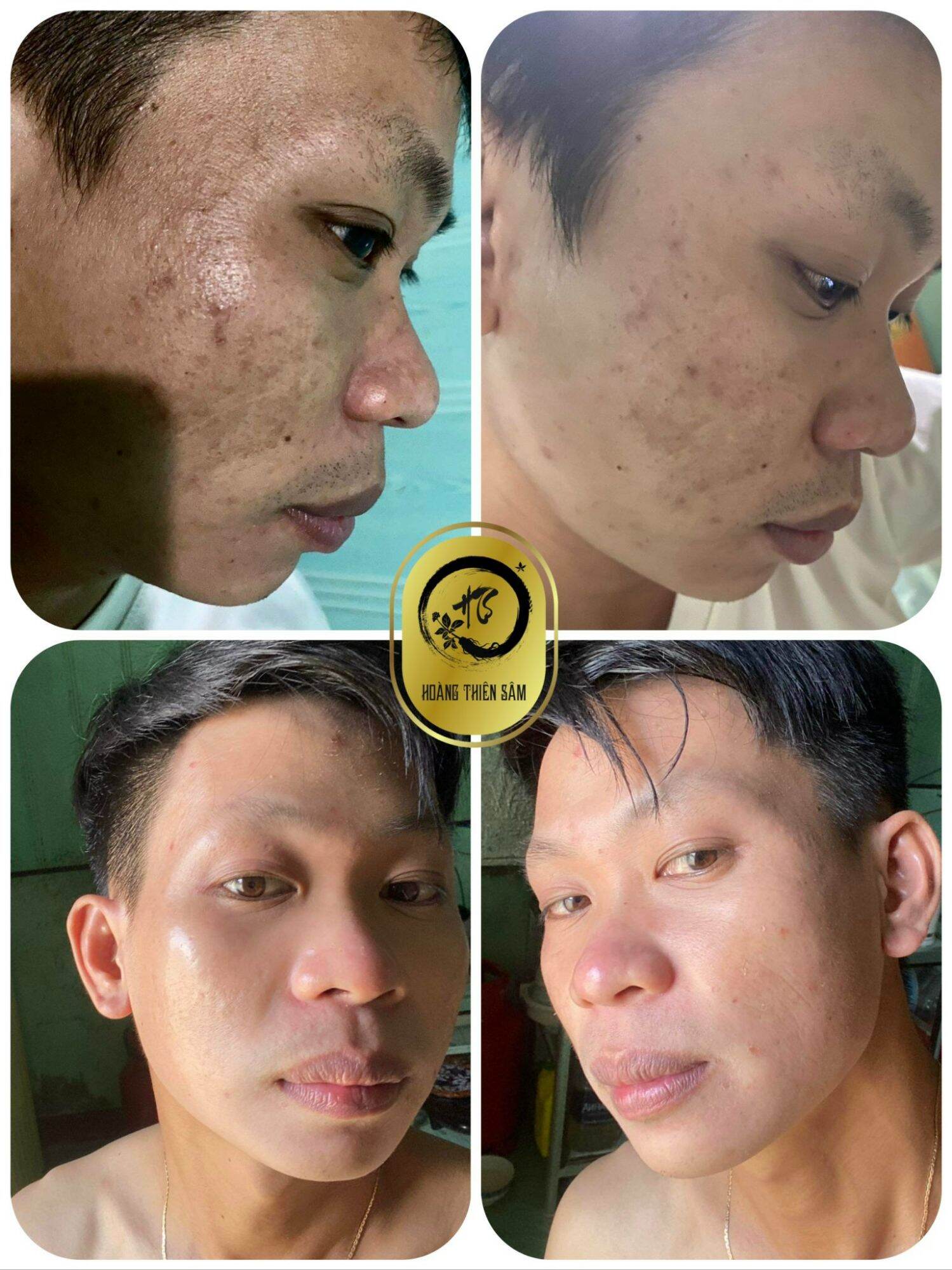 combo2 tinh chất Hoàng Thiên Sâm