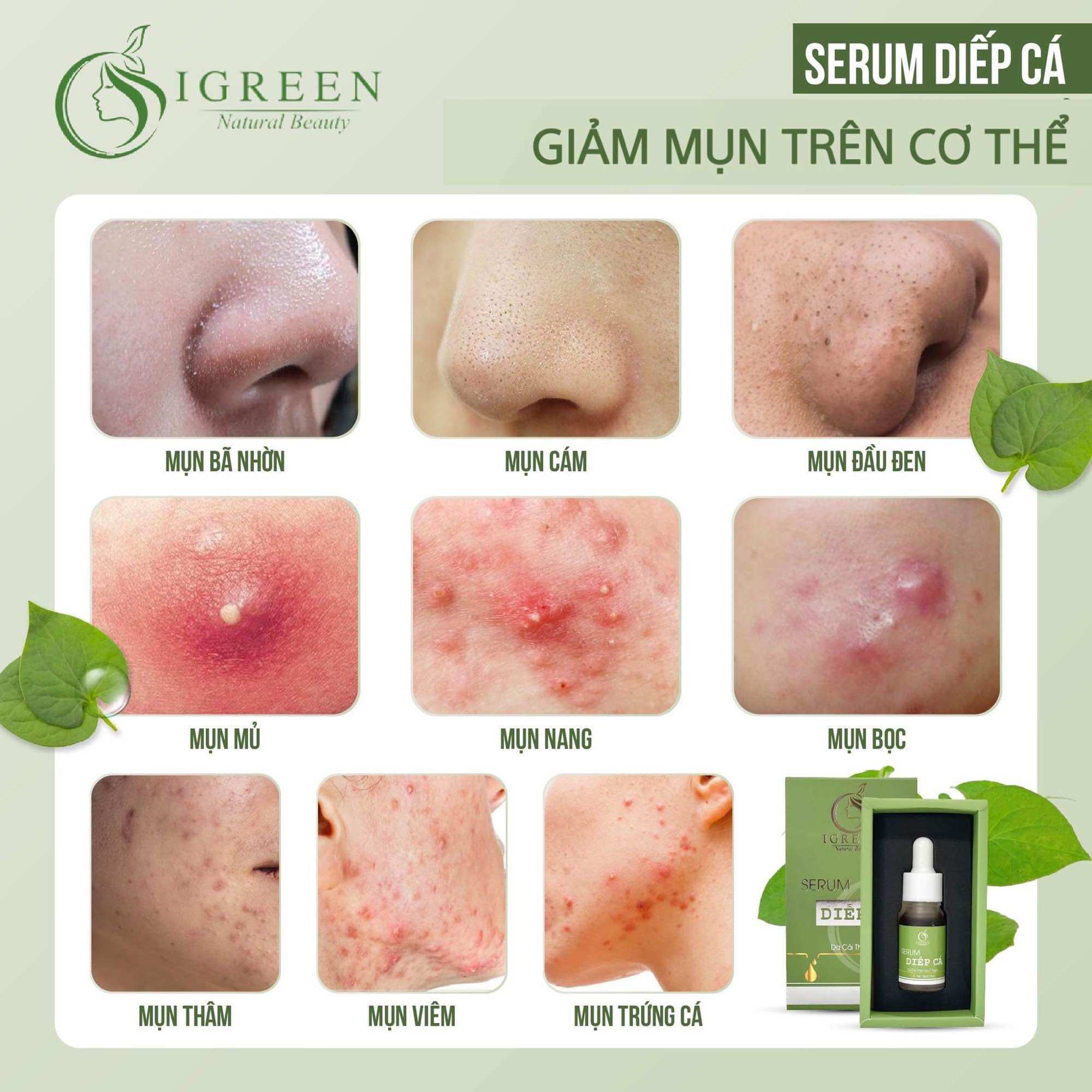 Combo Diếp Cá IGREEN (Sữa rửa mặt + Serum) – Sạch mụn, thâm