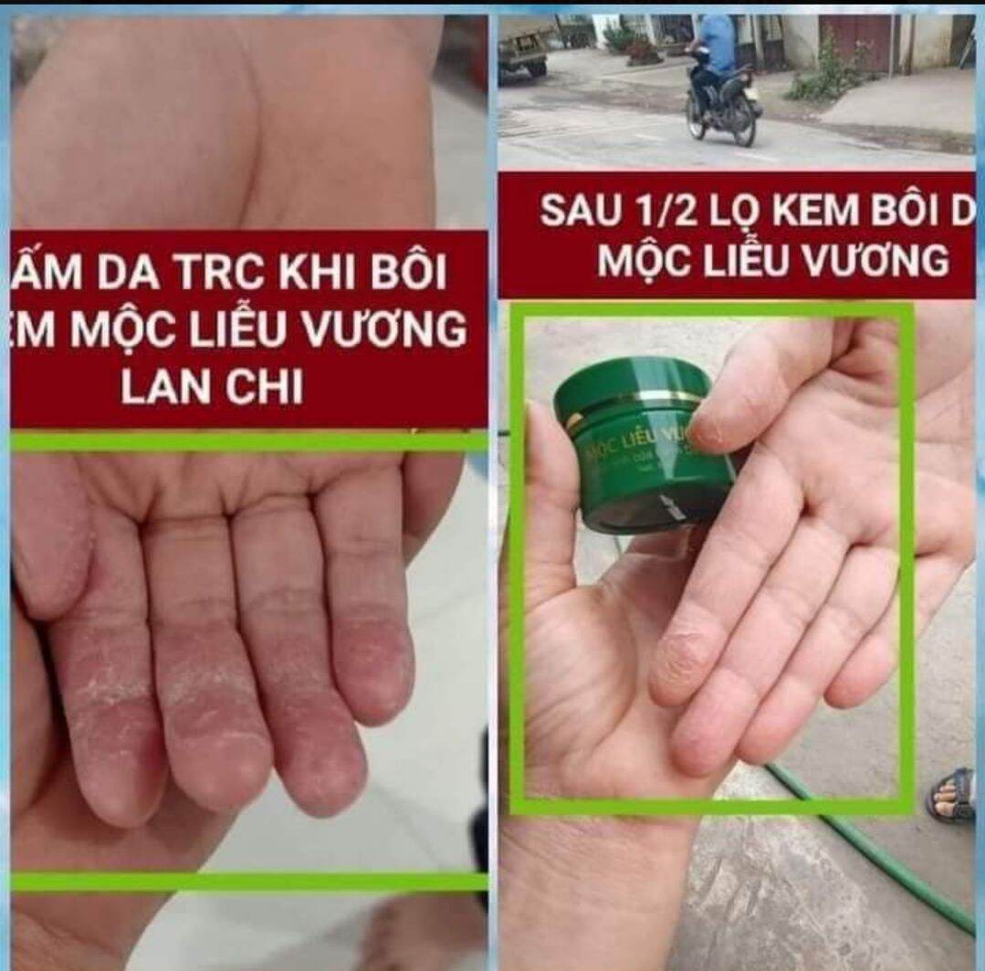 KEM BÔI DA MỘC LIỄU VƯƠNG (KHẮC TINH CÁC BỆNH VỀ DA )
