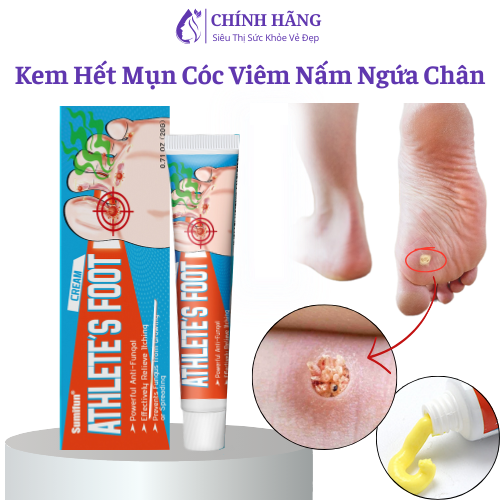 Kem Bôi Đánh Bay Mụn Cóc, Mụn Thịt Nấm Ngứa Chân Tay 20g