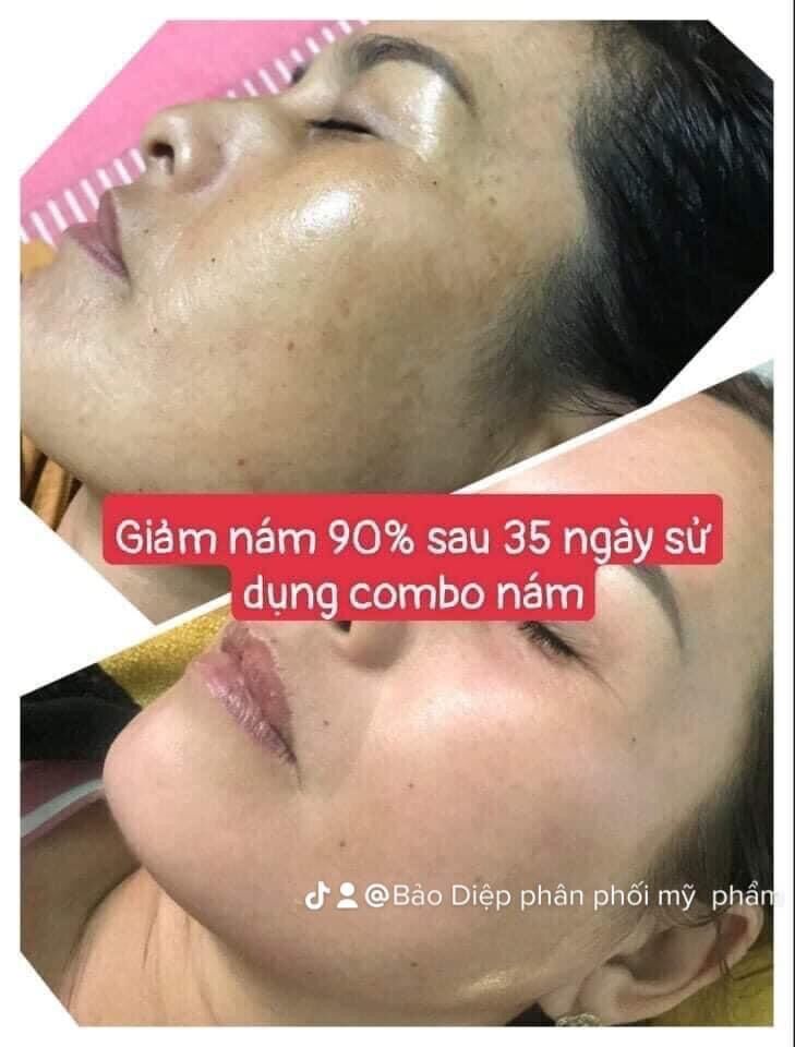 Combo 5 chai serum vitamin C trắng da ( bị mất vỏ xả lỗ )