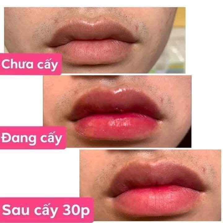 Tinh Chất Babier Lips Volume Làm Hồng Môi Xóa Thâm Môi Thay Phun Xăm