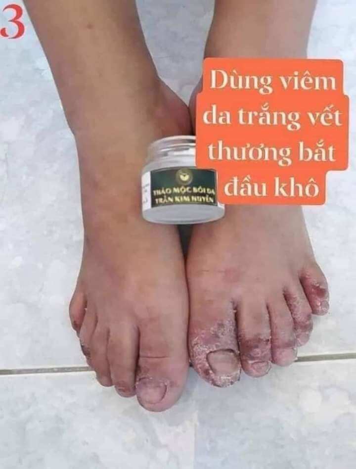 thảo mộc bôi da
