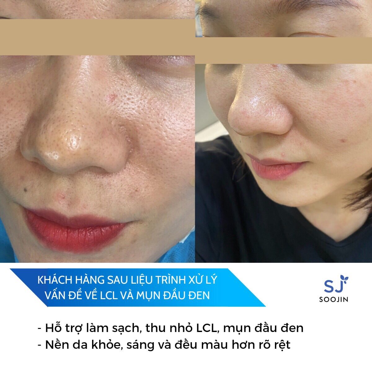 Kem thâm mụn nám soojin