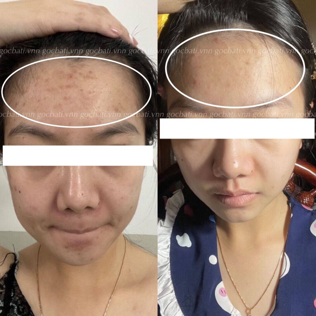 ANTI ACNE SERUM GBT