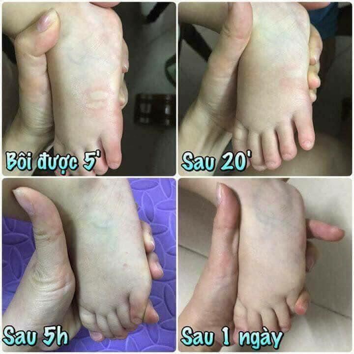 Lọ kem thoa muỗi đốt Thái Lan