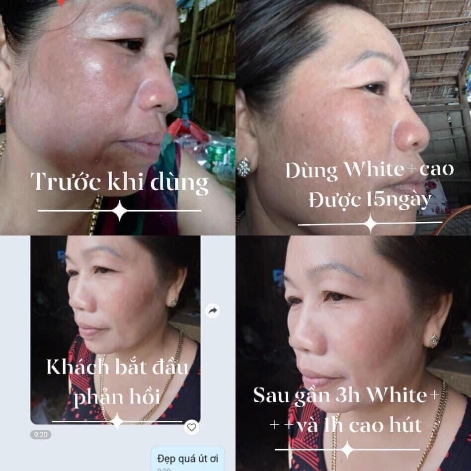 (Combo) Mờ NÁM CAO CẤP HUNA 1 L.TRÌNH HUNA
