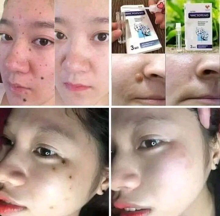 Gel tẩy nốt ruồi