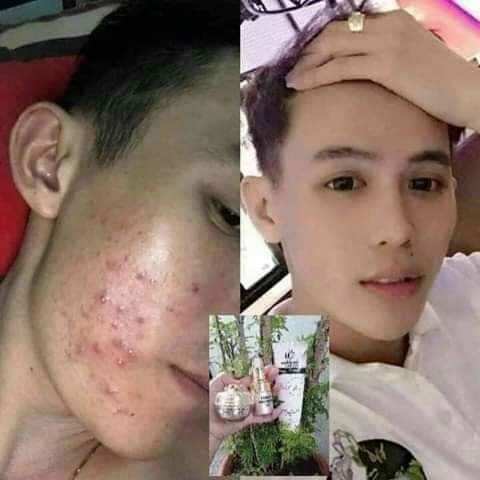 kem chuyên mụn huỳnh đỗ