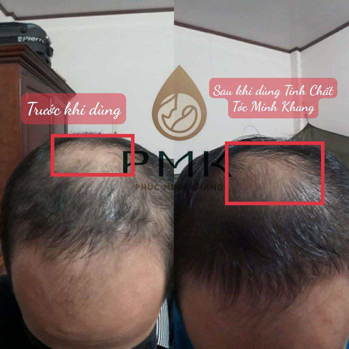 combo 2 Tinh Chất Mọc Tóc Cao Cấp Phúc Minh Khang