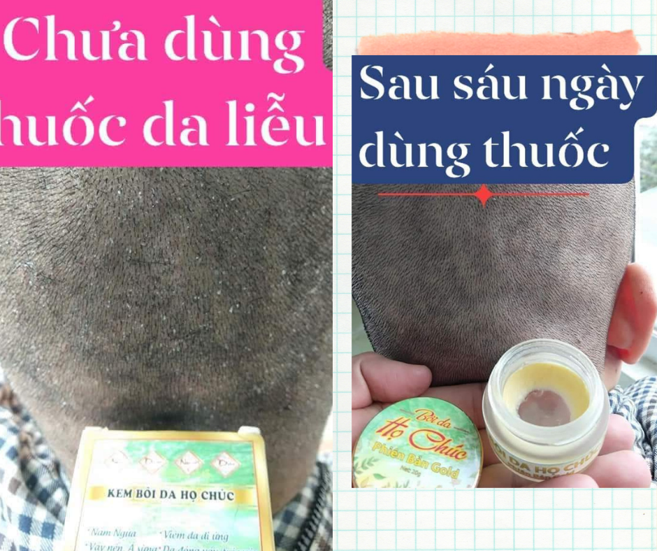 Kem Bôi Da Họ Chúc