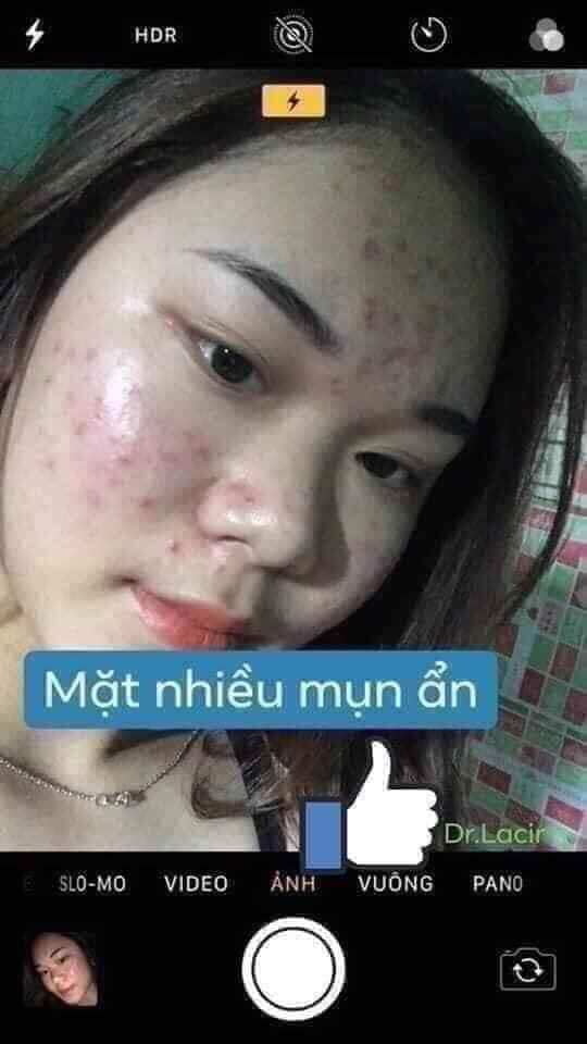 kem chuyên mụn huỳnh đỗ