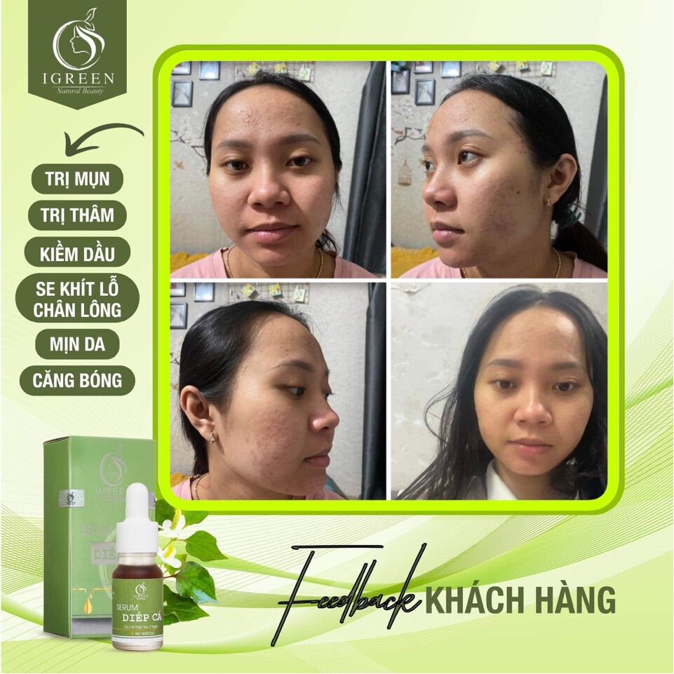 SERUM DIẾP CÁ GIẢM MỤN, THÂM, SE KHÍT LỖ CHÂN LÔNG - IGREEN