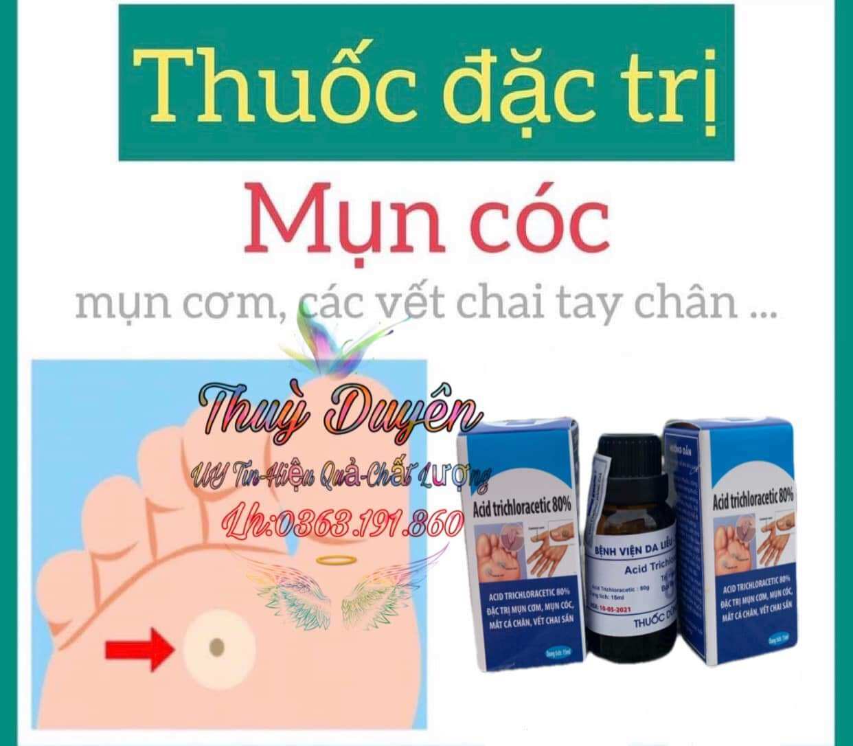 Mụn cóc Mụn cơm mắt cá chân tay vết chai sần
