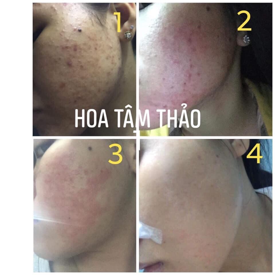 Combo thảo dược Hoa Tâm Thảo 100% thiên nhiên