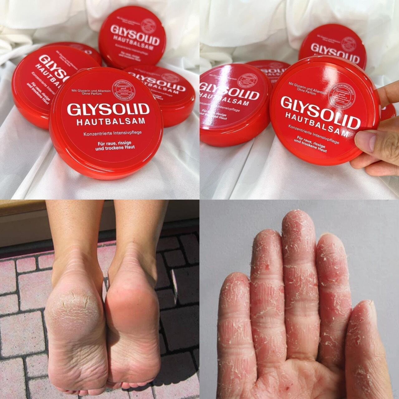 kem nẻ glysoid  á sưng,nứt nẻ hàng chuẩn đức