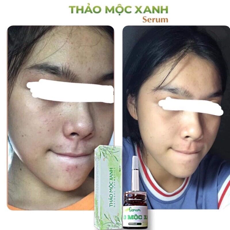 [Freeship] Serum Thảo Mộc Xanh 5ml