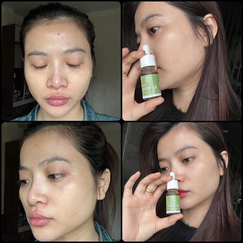 SERUM DIẾP CÁ GIẢM MỤN, THÂM, SE KHÍT LỖ CHÂN LÔNG - IGREEN