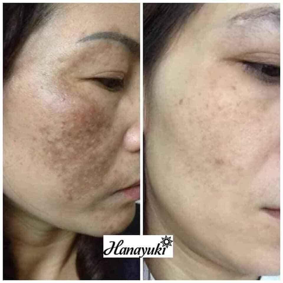 Serum Trị Nám Hanayuki - Hana Melasma
