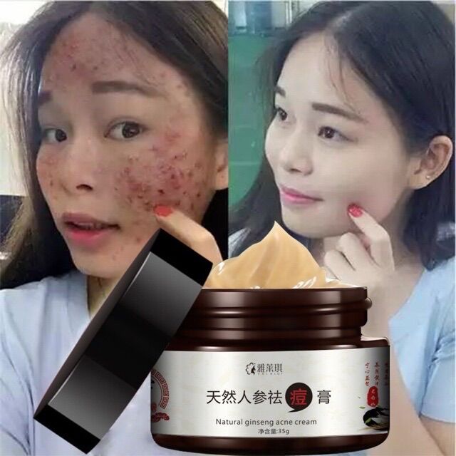 Kem giảm mụn chiết xuất nhân sâm