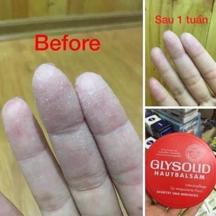 Kem nẻ GLYSOLID hũ 100ml