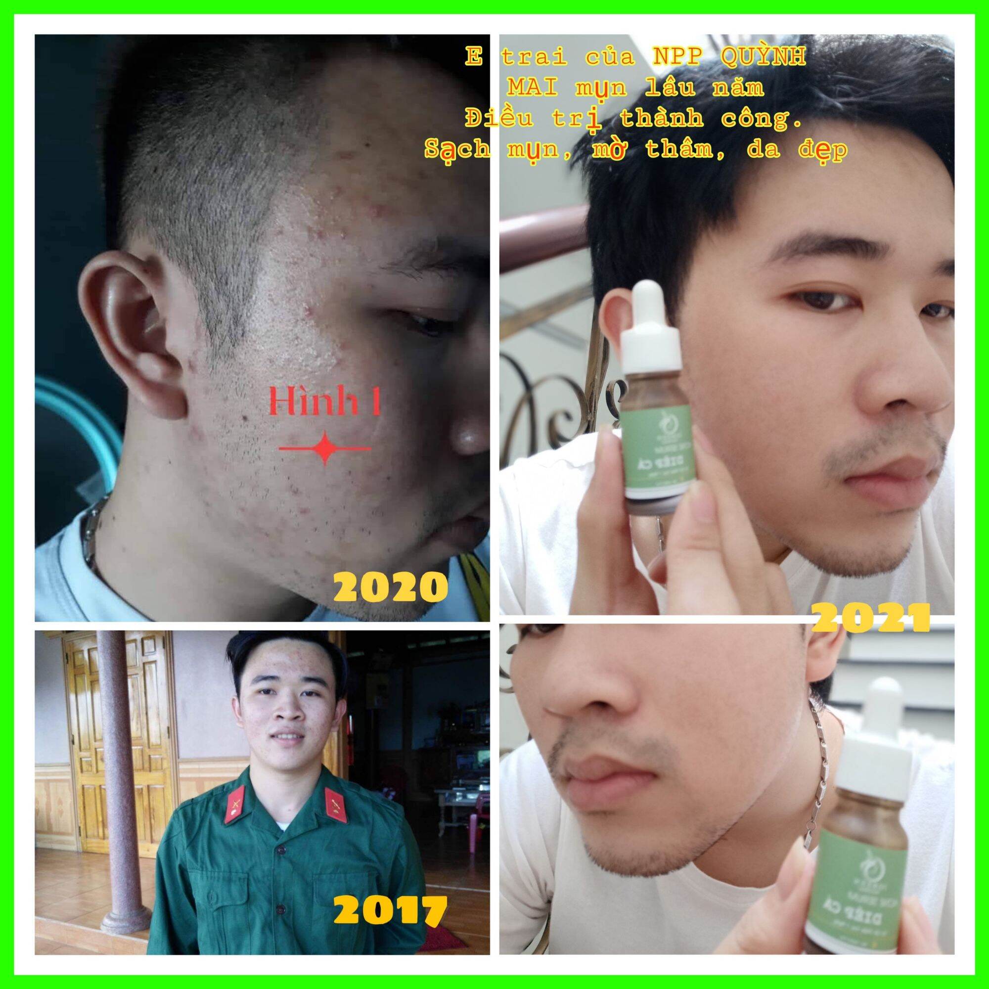 COMBO TOÀN DIỆN CHO DA HẾT MỤN, THÂM - COMBO DIẾP CÁ IGREEN