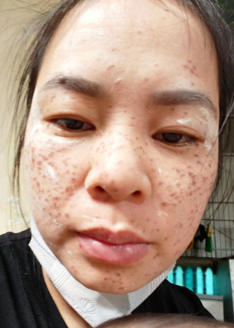 chấm tàn nhang, nám, sẹo rổ, nốt ruồi. mụn thịt, bán đinh( tuyệt đối ko bôi nguyên chất)  sp dành cho spa.