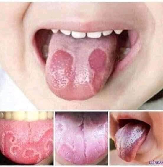 Sâu răng nhật Dương_ sâu sún răng Nấm lưỡi