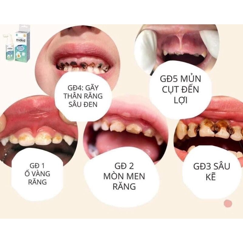 MIDKID xịt chống sâu răng chống hôi miệng