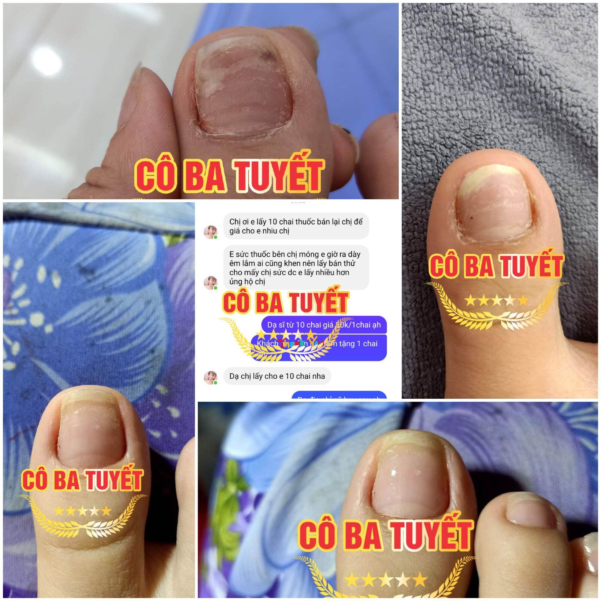 Cô Ba Tuyết . Nấm móng , Bọng Móng , Hư Khóe 2 chai 3ml